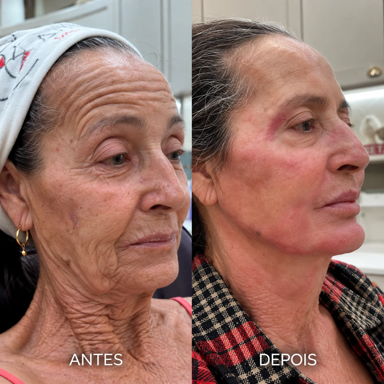 Comparativo antes e depois — Máquina de Contorno